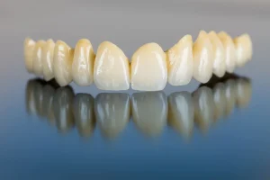 dental bridge cost philippines