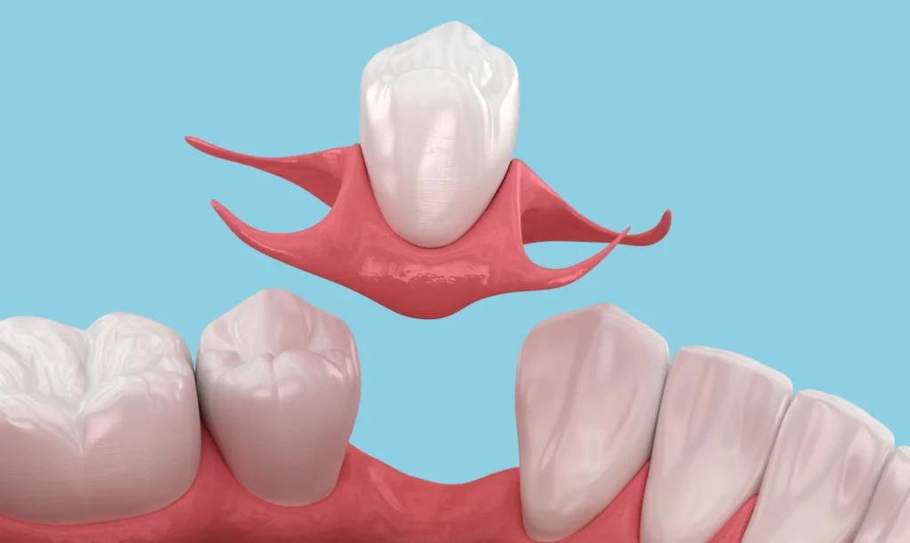 1 Tooth Denture Price