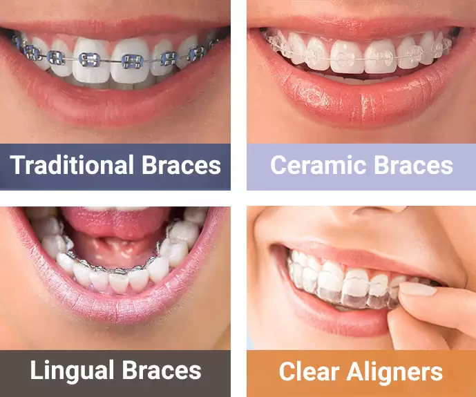 Lingual Braces vs. Traditional Metal Braces