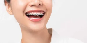 Metal Braces Price in the Philippines