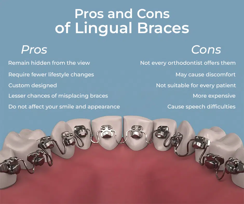 Pros and Cons of Lingual Braces