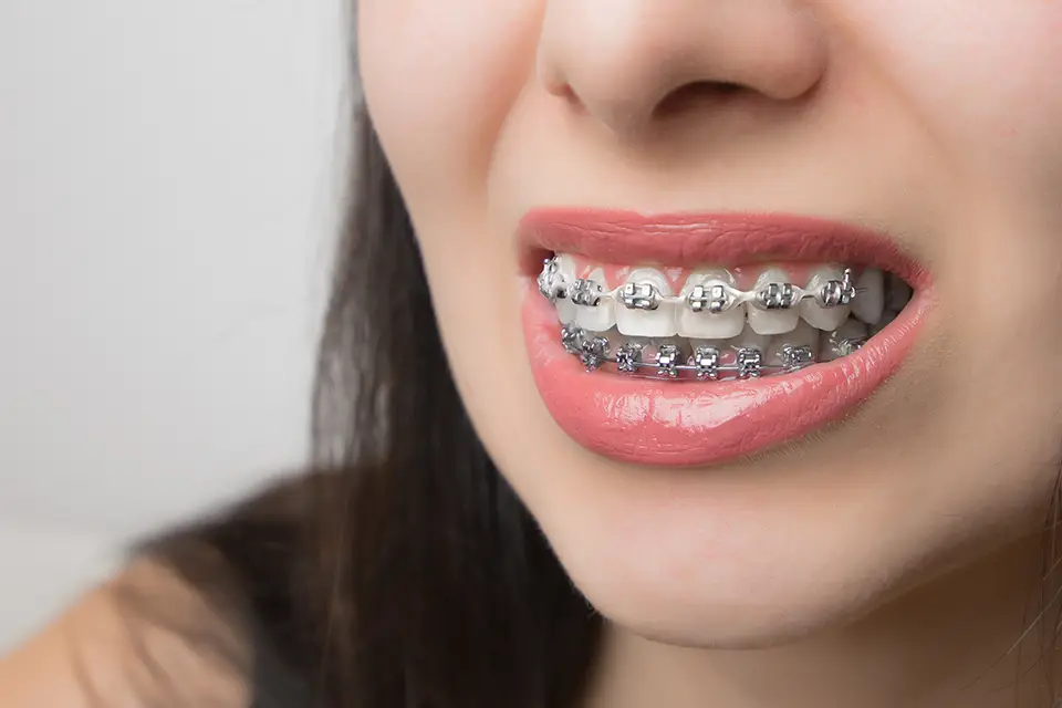 What Are Metal Braces