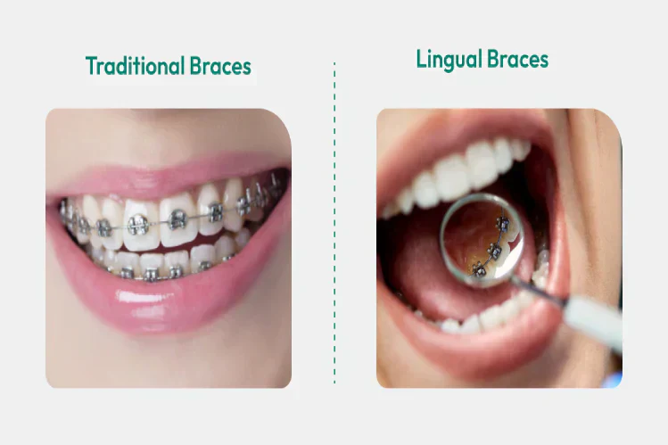 Who Are Lingual Braces Best For