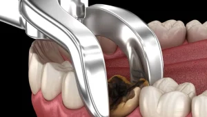 wisdom tooth extraction price