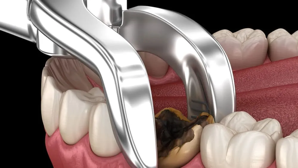 wisdom tooth extraction price