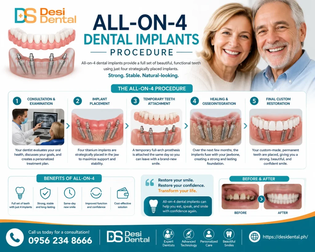 All-on-4 Dental Implants Procedure