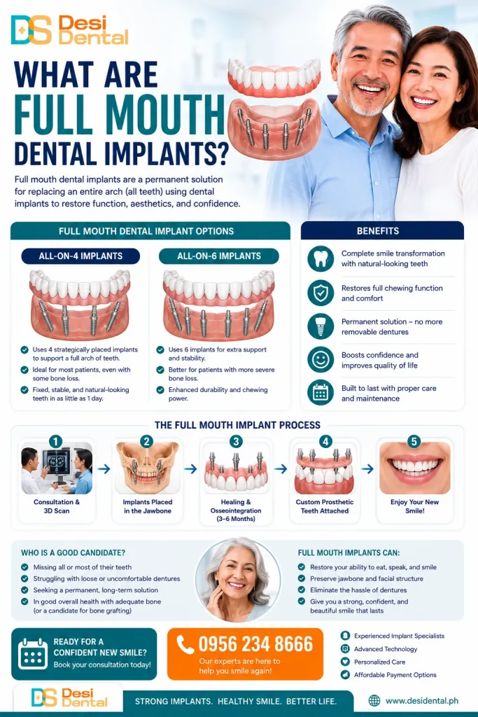Full Mouth Dental Implants