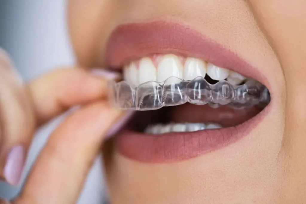 What Are Clear Aligners