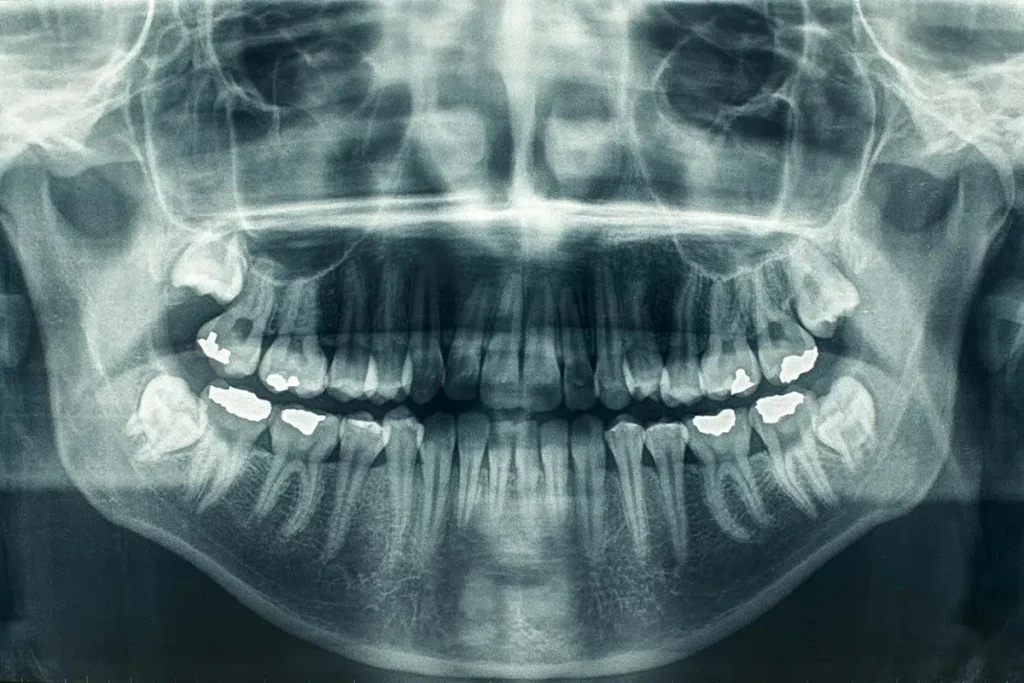 Why Panoramic X-Ray is Essential for Dental Care