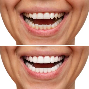 Zirconia Crown Price