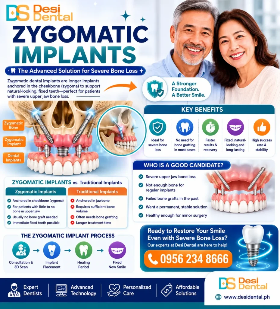 Zygomatic Implants