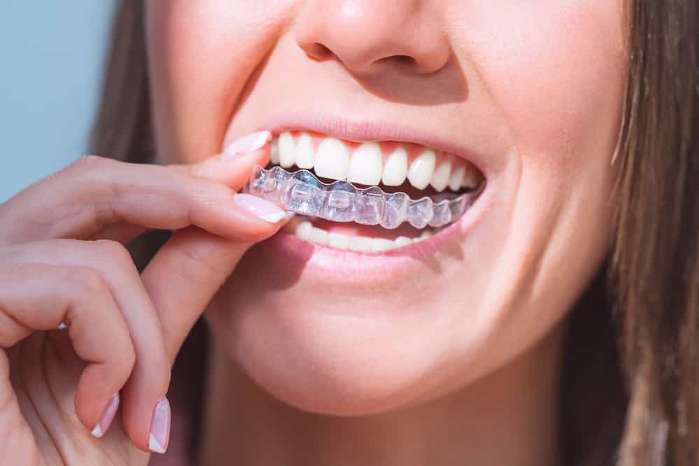 invisible retainer