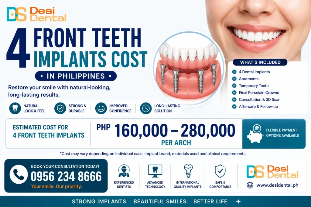 4 Front Teeth Implants Cost in Philippines