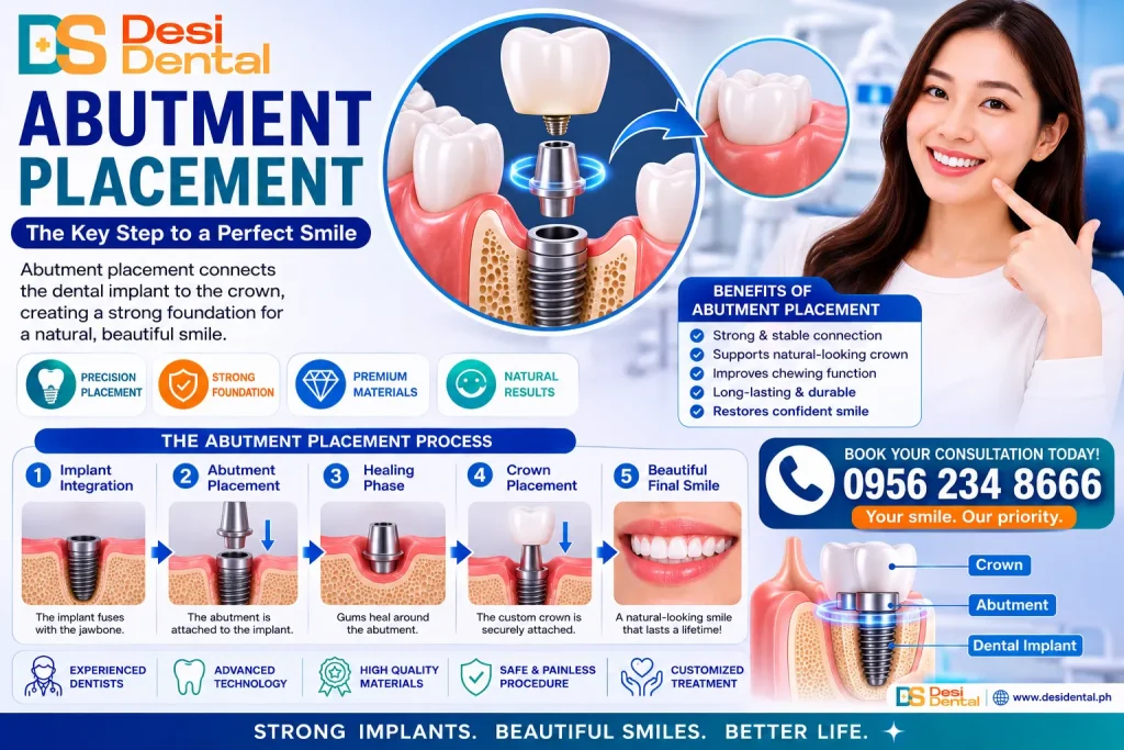 Abutment Placement