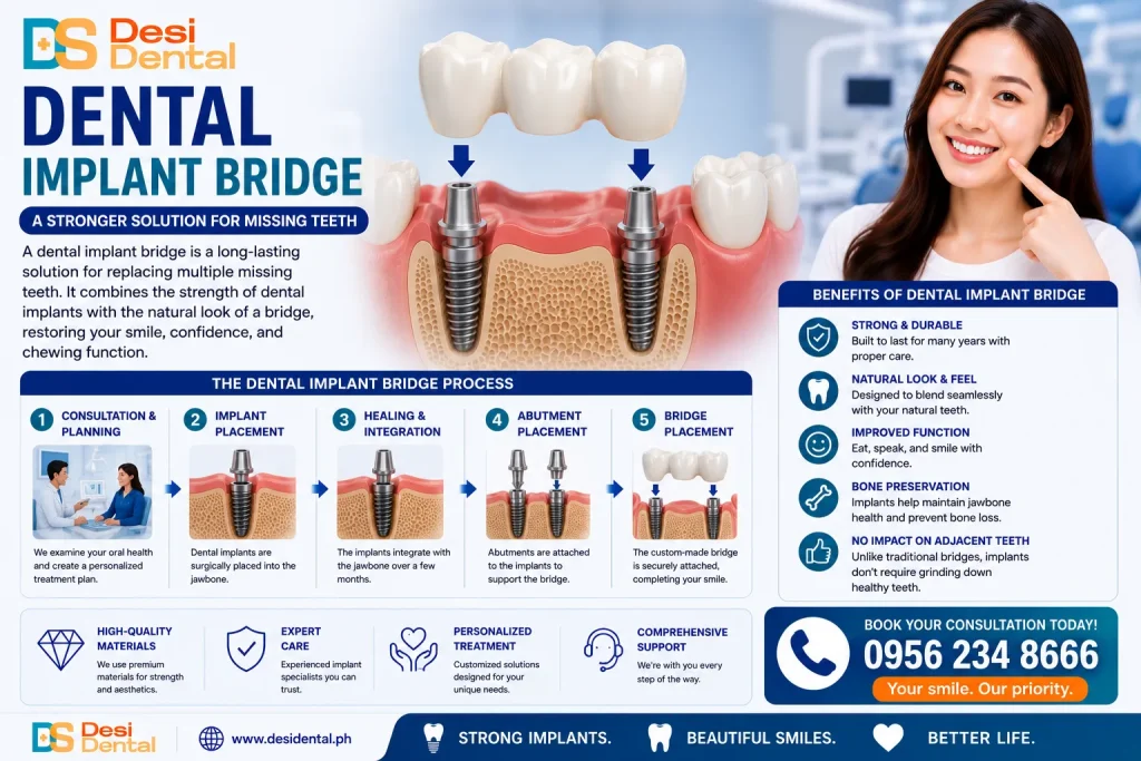 Dental Implant Bridge