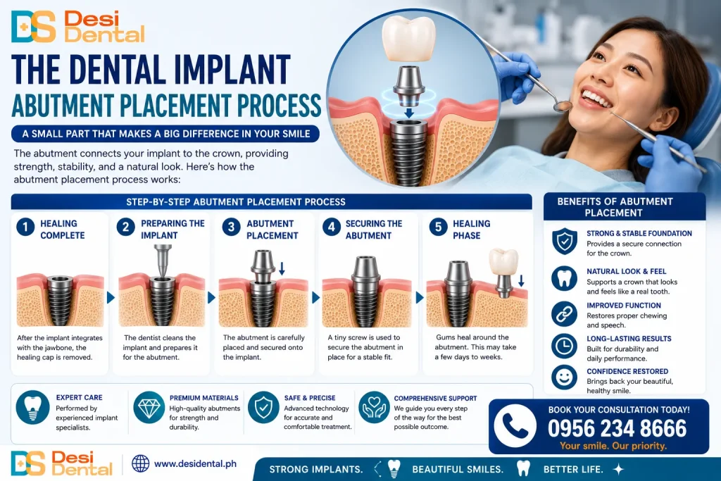 The Dental Implant Abutment Placement Process