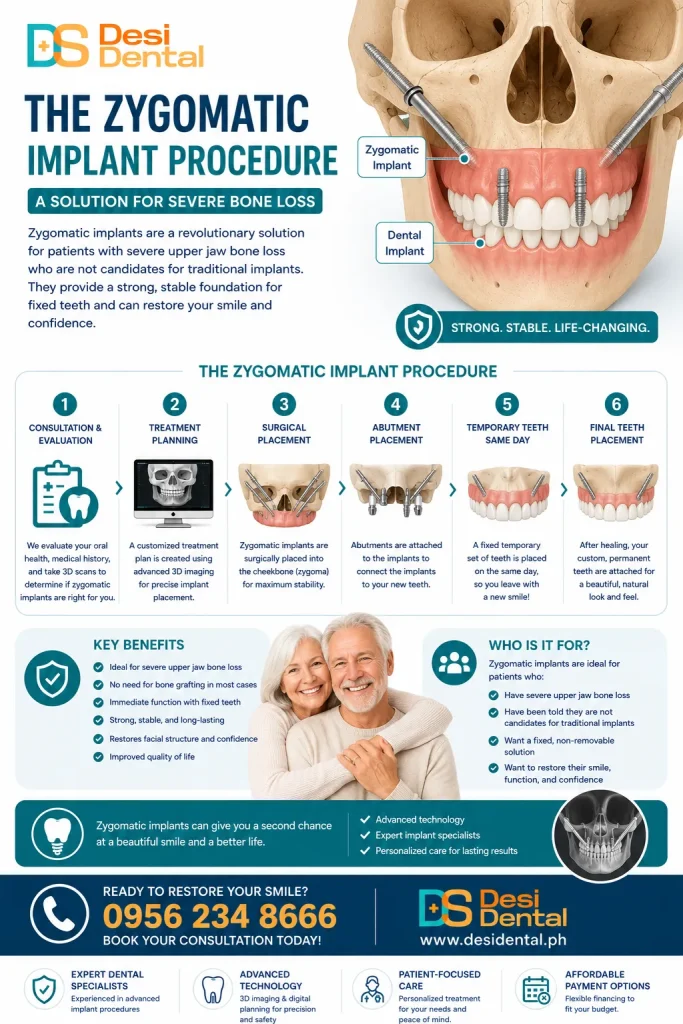 The Zygomatic Implant Procedure