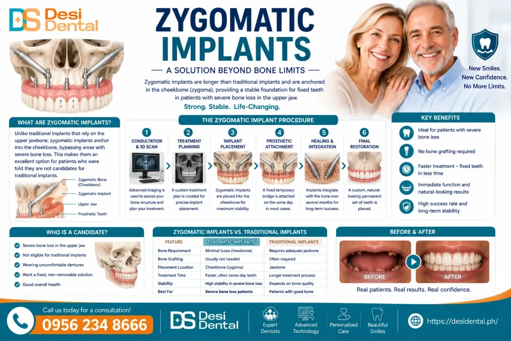 Zygomatic Implants