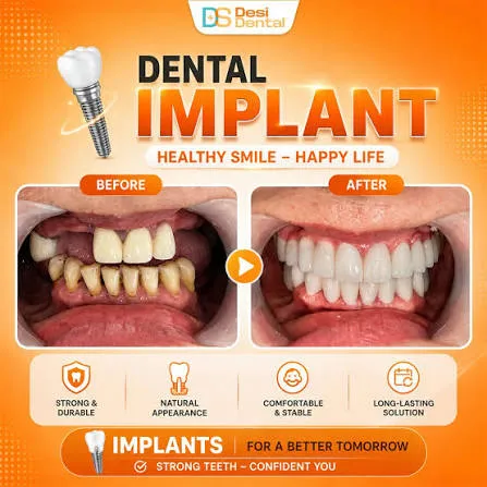 Dental Implant Clinics in Metro Manila