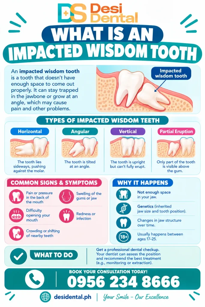 What Is an Impacted Wisdom Tooth
